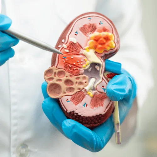 Manejo integral de la enfermedad renal crónica en Metepec