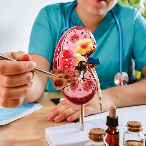 Abordaje especializado de la glomerulonefritis en Metepec